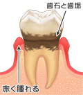 歯ぐきが赤く腫れ始めた状態