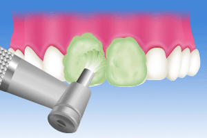 3.歯の表面のクリーニング