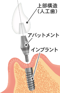 インプラントのイラスト