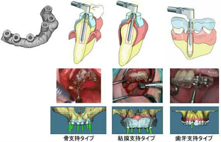 サージカルガイドの写真