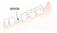 歯肉切開のイラスト