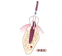 ネジで歯冠をインプラントに固定