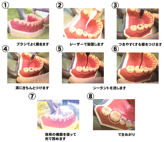 シーラントの手順の写真