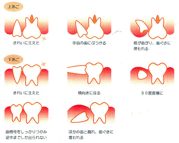親知らずの生え方のイラスト