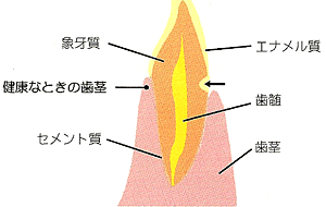 知覚過敏のイラスト