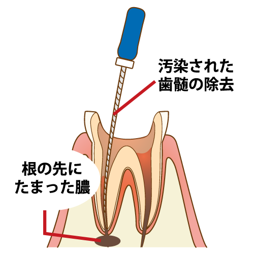 根管治療のイラスト