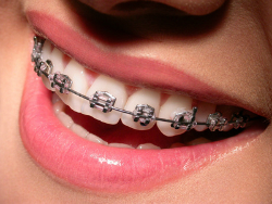 矯正器具を装着した歯の写真