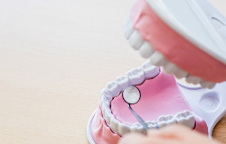 これは親知らず？奥歯に痛みが！
